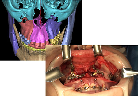 Figur 4. Virtuell kirurgisk planlegging. LeFort I med segmentering av maxillen for å optimalisere sambittet.